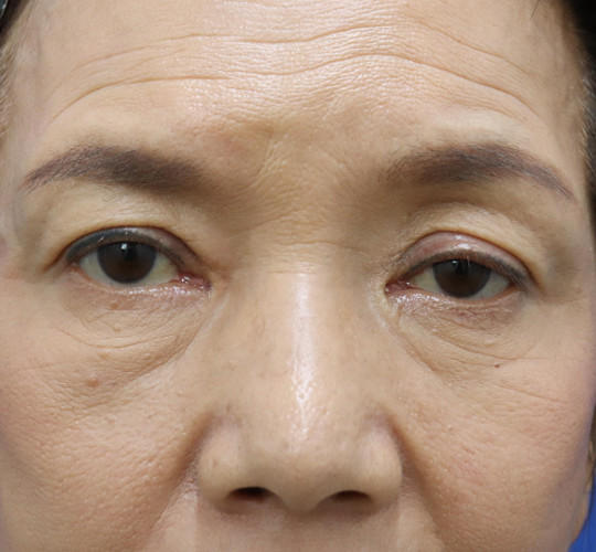60代女性の眼瞼下垂 Before 症例写真