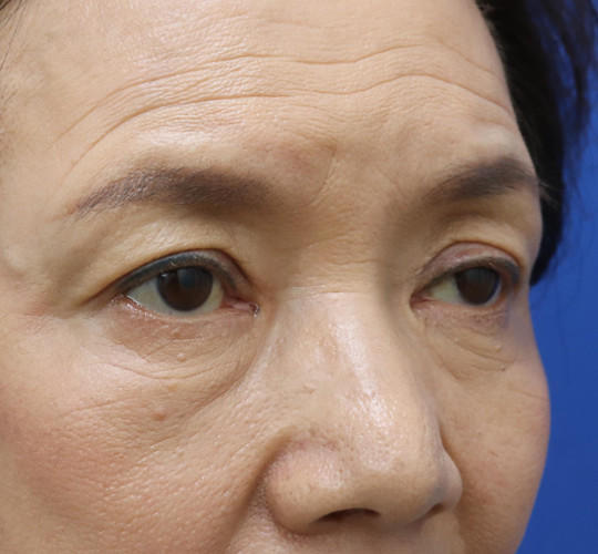 60代女性の眼瞼下垂 Before 症例写真