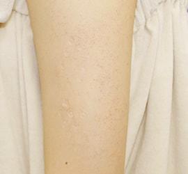 10代女性のFotonaフラクショナルレーザー（毛孔性苔癬） After 症例写真