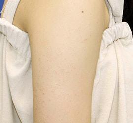 10代女性の毛孔性苔癬・角化症 After 症例写真