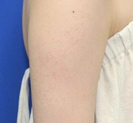 10代女性の毛孔性苔癬・角化症 Before 症例写真