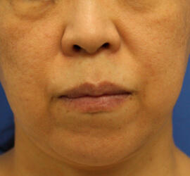 50代女性のフラクセル After 症例写真