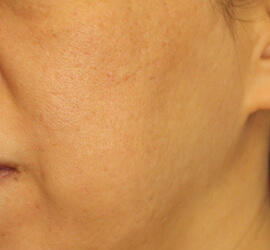 50代女性のフラクセル After 症例写真