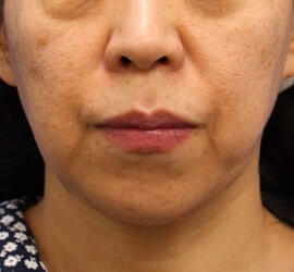 50代女性のフラクセル Before 症例写真