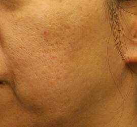 50代女性のフラクセル Before 症例写真