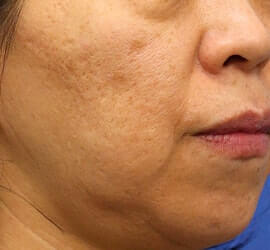 50代女性のフラクセル Before 症例写真