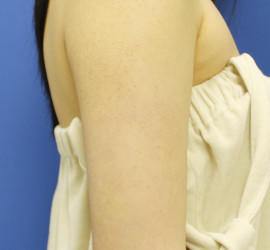 20代女性のFotonaフラクショナルレーザー（毛孔性苔癬） Before 症例写真