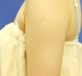 20代女性の毛孔性苔癬・角化症 After 症例写真