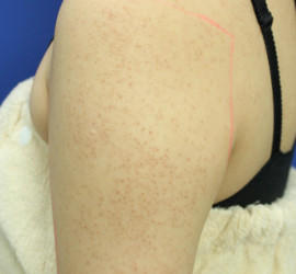 20代女性の毛孔性苔癬・角化症 Before 症例写真