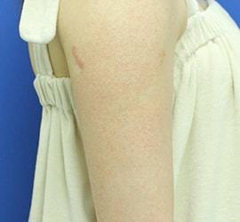 20代女性のFotonaフラクショナルレーザー(毛孔性苔癬) Before 症例写真