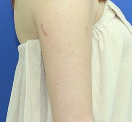 20代女性の毛孔性苔癬・角化症 After 症例写真
