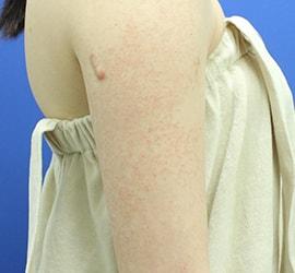 20代女性の毛孔性苔癬・角化症 Before 症例写真
