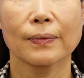 50代女性のヒアルロン酸注射（ほうれい線） After 症例写真