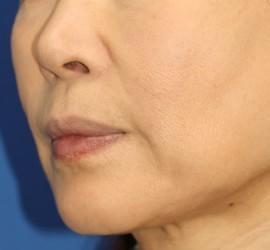 50代女性のヒアルロン酸注射 After 症例写真