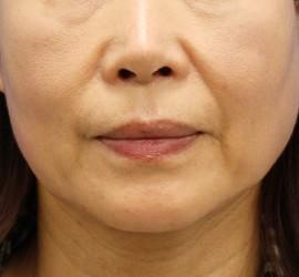 50代女性のヒアルロン酸注射（ほうれい線） Before 症例写真