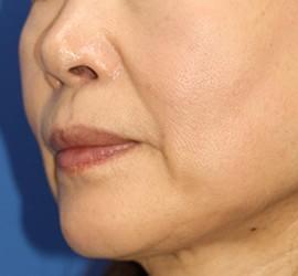 50代女性のヒアルロン酸注射 Before 症例写真