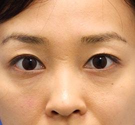 30代女性の目の下の脱脂 After 症例写真