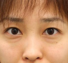 30代女性の目の下の脱脂 Before 症例写真
