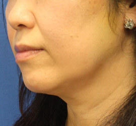 40代女性の After 症例写真