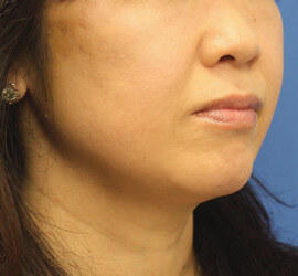 40代女性の After 症例写真