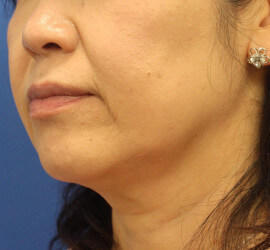 40代女性の Before 症例写真