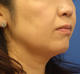 40代女性の Before 症例写真