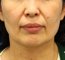 50代女性のサーマクール Before 症例写真