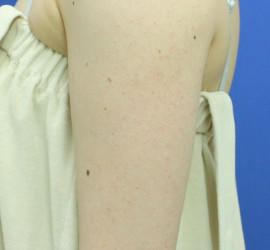 30代女性の毛孔性苔癬・角化症 Before 症例写真