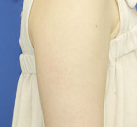 30代女性のFotonaフラクショナルレーザー（毛孔性苔癬） After 症例写真