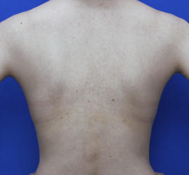 30代女性の毛孔性苔癬・角化症 Before 症例写真