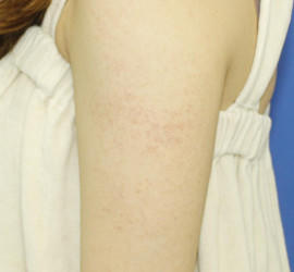 20代女性の毛孔性苔癬・角化症 Before 症例写真