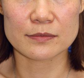 40代女性のヒアルロン酸注射  After 症例写真