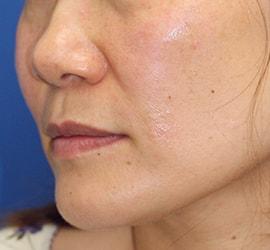 40代女性のヒアルロン酸注射  After 症例写真