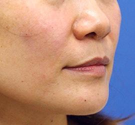 40代女性のシワ・たるみ After 症例写真