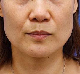 40代女性のヒアルロン酸注射  Before 症例写真