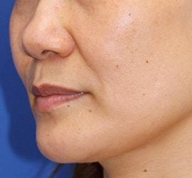 40代女性のヒアルロン酸注射  Before 症例写真