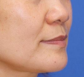 40代女性のシワ・たるみ Before 症例写真