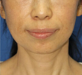 50代女性のシワ・たるみ After 症例写真