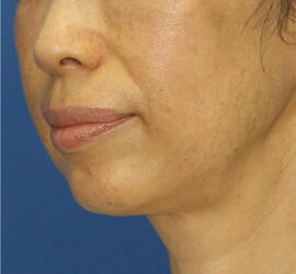 50代女性の After 症例写真