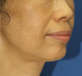 50代女性の After 症例写真