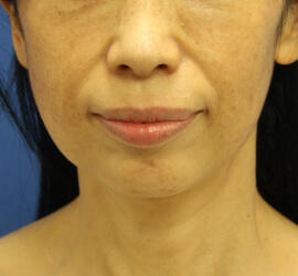50代女性のシワ・たるみ Before 症例写真