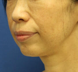 50代女性の Before 症例写真