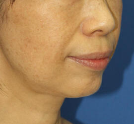 50代女性の Before 症例写真