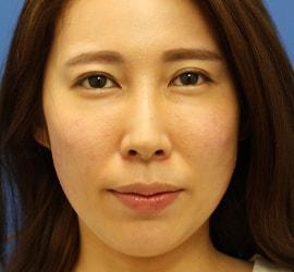 30代女性のヒアルロン酸注射(目の下) After 症例写真