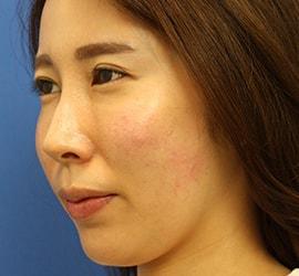 30代女性のヒアルロン酸注射（目の下） After 症例写真