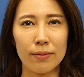 30代女性のヒアルロン酸注射(目の下) Before 症例写真