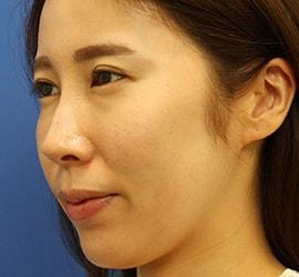 30代女性のヒアルロン酸注射（目の下） Before 症例写真