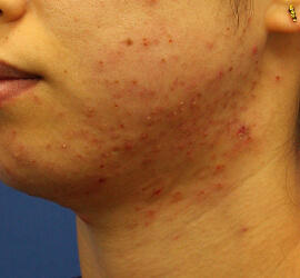 20代女性の小林式ニキビ治療法 After 症例写真