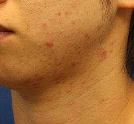 20代女性の小林式ニキビ治療法 Before 症例写真