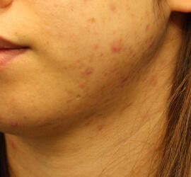 20代女性の小林式ニキビ治療法 Before 症例写真